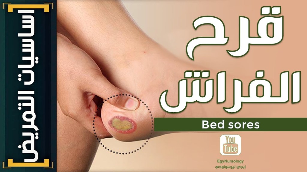 اساسيات التمريض | (4) كل ما يخص (bed sores) قرح الفراش